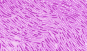 Microscopic view of sarcomatoid mesothelioma cells